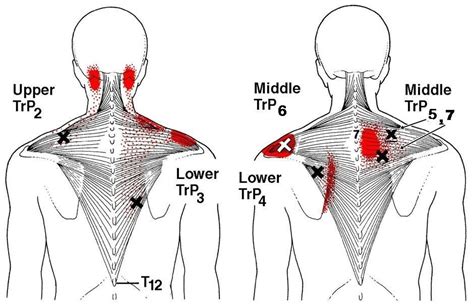 back trigger points | Tight shoulders, Upper back pain, Stiff neck