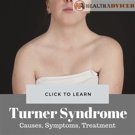 Turner Syndrome: Causes, Picture, Symptoms and Treatment