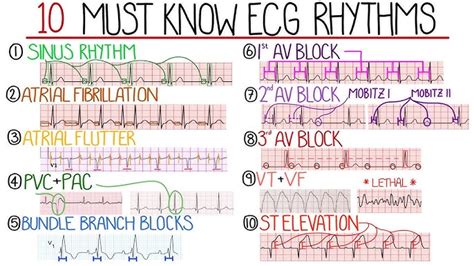 Ecg Reading 44 High Quality | www.gbu-presnenskij.ru