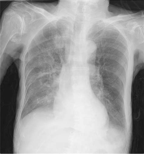 Bochdalek Hernia - Congenital Diaphragmatic Hernia Thoracic Key ...