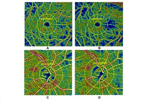 | Optical coherence tomography angiographic images of the parafoveal ...