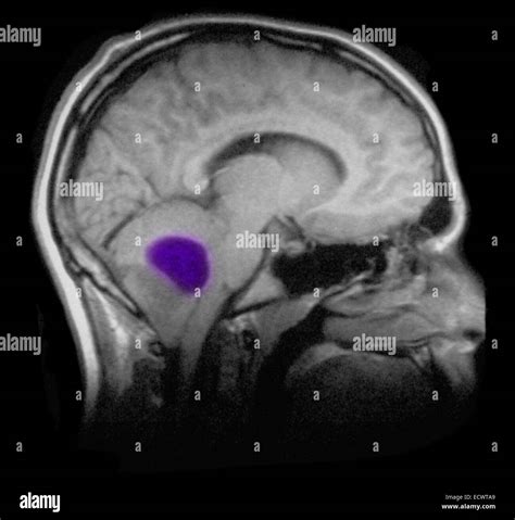 Pilocytic astrocytoma of the brain as seen on MRI scan Stock Photo - Alamy