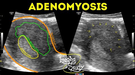 Adenomyosis || Ultrasound || Case 42 - YouTube