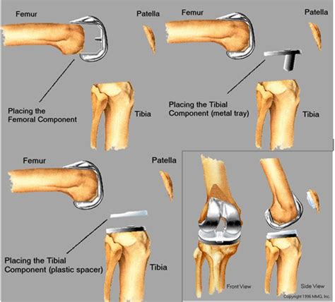 Knee Replacement (Total or Partial)