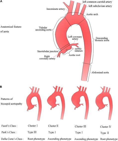 Frontiers | Aortic Dilatation in Patients With Bicuspid Aortic Valve