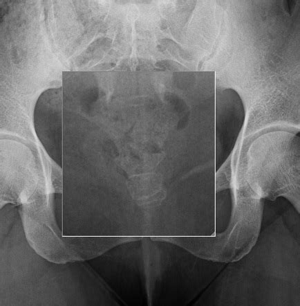 Coccyx X Ray Positioning