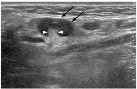 Transverse greyscale sonogram in a patient with reactiv | Open-i