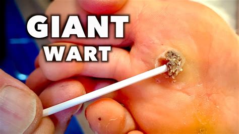 Plantar Wart Root Removal | Bruin Blog