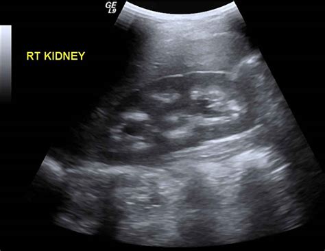 Nephrocalcinosis definition, types, causes, symptoms, diagnosis & treatment