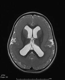 Lissencephaly - Physiopedia