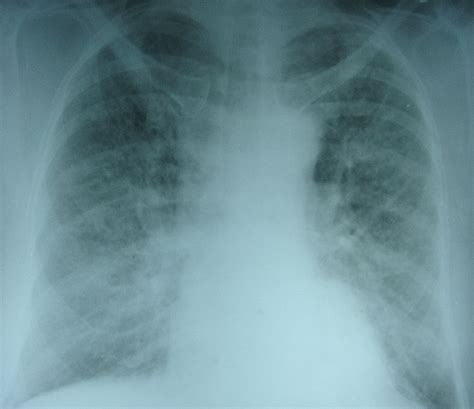 Pulmonary edema – X-ray chest PA view – All About Cardiovascular System ...