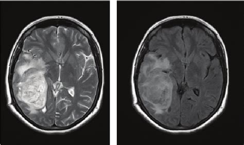 T2 weighted (a) and (b) FLAIR MR images of the lesion before second ...