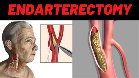 WHAT IS ENDARTERECTOMY? - Carotid Endarterectomy Surgery, Indications ...