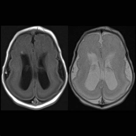 Newborn with hydrocephalus on prenatal ultrasound | Pediatric Radiology ...