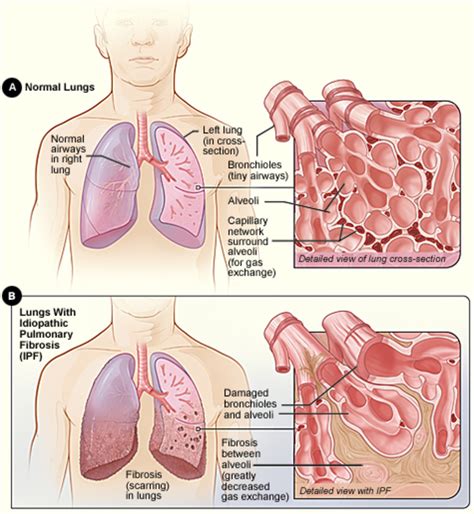 Cystic Fibrosis and General Fibrosis - Definition, Causes and ...