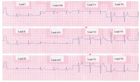 Lead Surface Electrocardiogram Ecg Of Typical Atrial Flutter | The Best ...