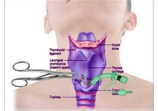 LARYNGEAL OBSTRUCTION. | PPT