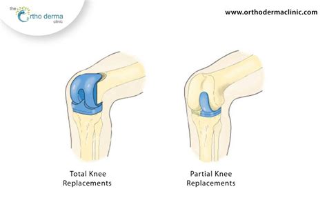 Knee Replacements Vs. Partial Knee Replacements