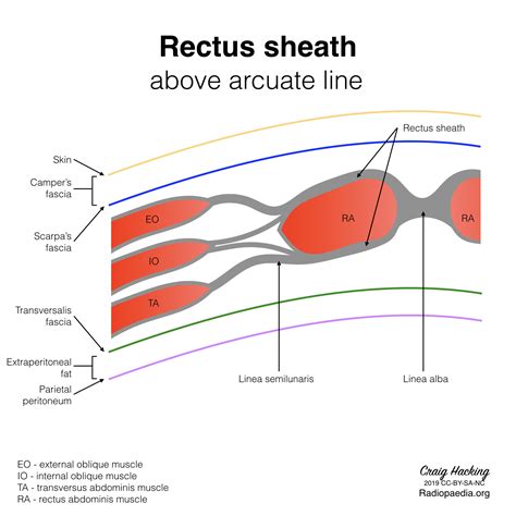 Radiopaedia - Drawing Rectus sheath above arcuate line - English labels ...