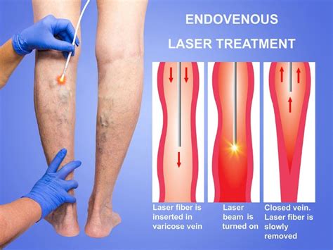 Endovenous Laser Treatment For Varicose Veins - Varicose Vein Laser