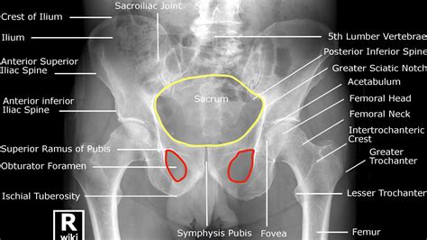 Hip X-ray Interpretation - OSCE Guide | Geeky Medics