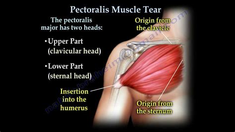 Pectoralis Muscle ,tendon Tear - Everything You Need To Know - Dr ...