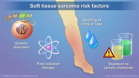 Diagnosing and Treating Soft Tissue Sarcoma