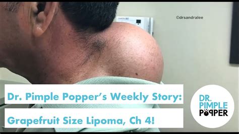 Dr. Pimple Popper's Weekly Story: Grapefruit Size Lipoma Final Chapter ...