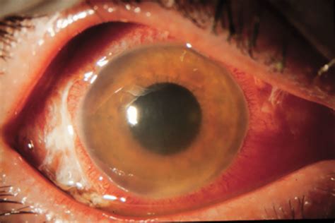 Uveitis, Uveitis Eye - Causes, Types, Symptoms, Diagnosis, Treatment