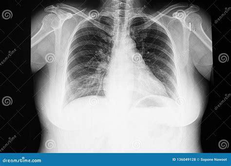 Cardiomegaly With Congestive Heart Failure Stock Photography ...