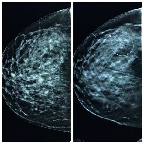 Breast Cancer Digital Mammogram