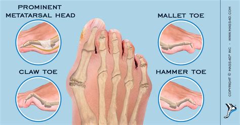 What Causes Foot Deformities - Design Talk