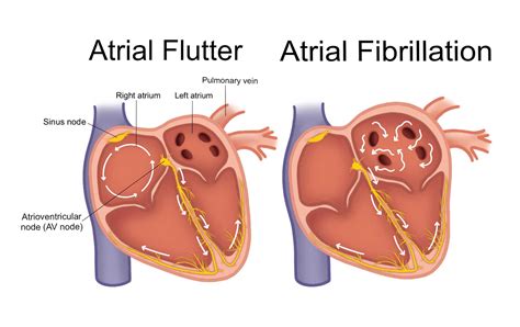 Atrial Flutter Vs Atrial Fibrillation