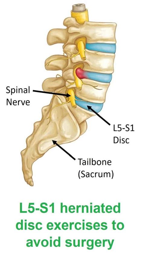 Herniated disc treatment L5-S1 with 3 exercises to avoid surgery