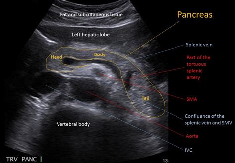 Image | Radiopaedia.org