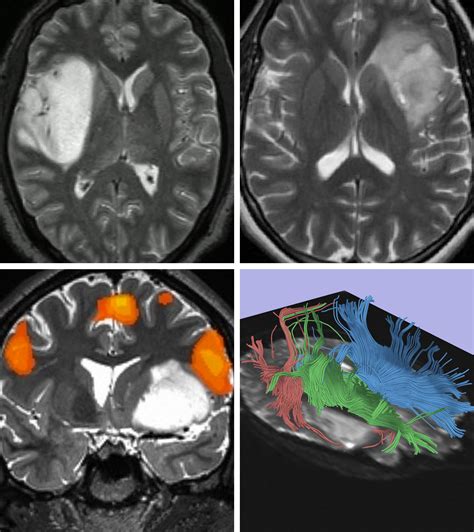 Insular Cortex Fmri