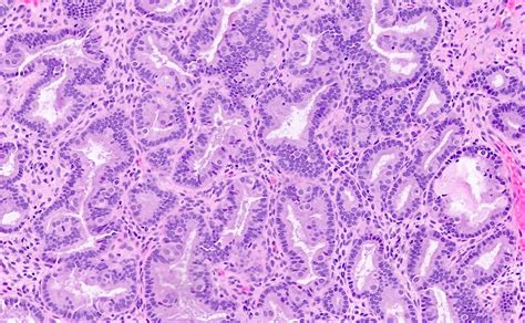 Pathology Outlines - Endometrial hyperplasia