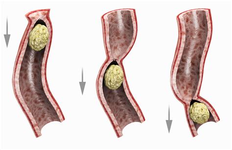 Ileus: Symptoms, Causes, and Treatment