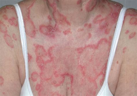 ACD A-Z of Skin - Cutaneous Lupus Erythematosus