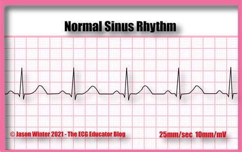 ECG Educator Blog : Normal Sinus Rhythm