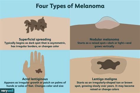 Melanoma: Symptoms, Staging, Treatment, and More