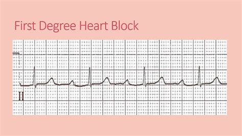 Study Medical Photos: ECG Findings In Different Types Of Heart Block.