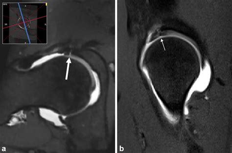 MRI hip arthrogram with radial MPR (slice thickness 1 mm) of an ...