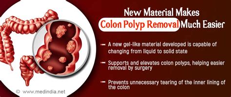 New Material Could Make Removal of Colon Polyps Much Easier: Here’s How