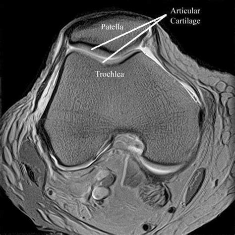 Magnetic Resonance Imaging (MRI) - Specialist Knee Surgeon in ...