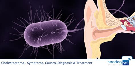 Cholesteatoma Symptoms, Causes, Diagnosis & Best Treatment