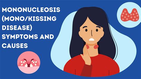 Mononucleosis (Mono/Kissing Disease): Symptoms and Causes | Sprint Medical