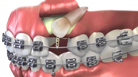 Impacted Canine Tooth Surgery in Ventura, CA - Pacific Oral Surgery