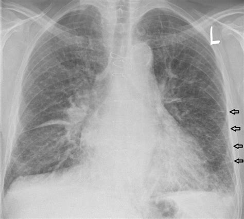 Pulmonary edema chest x ray - wikidoc