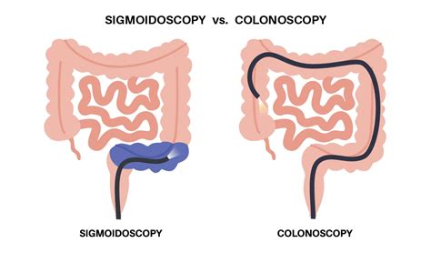 Flexible Sigmoidoscopy | Advocate Health Care